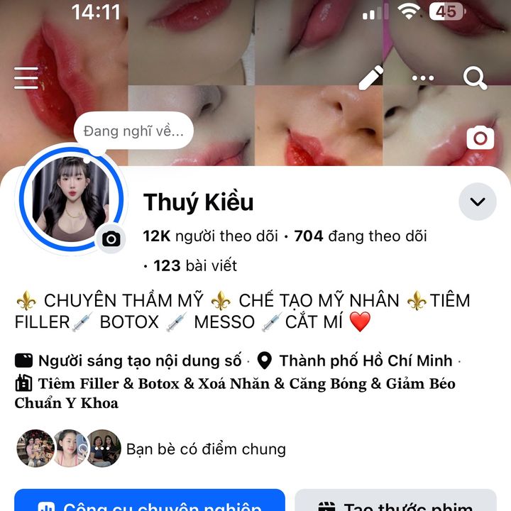 Tiêm Filler Bình Dương
