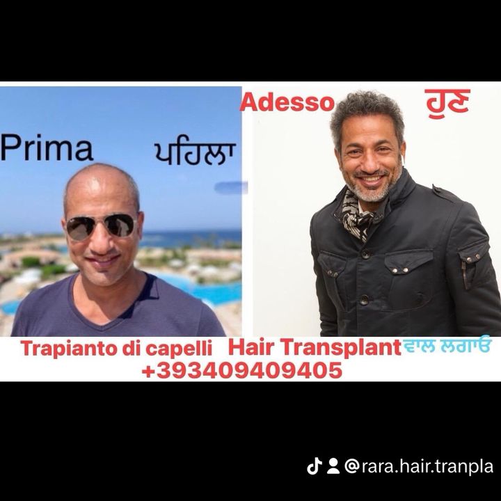 rara_hair_transplant