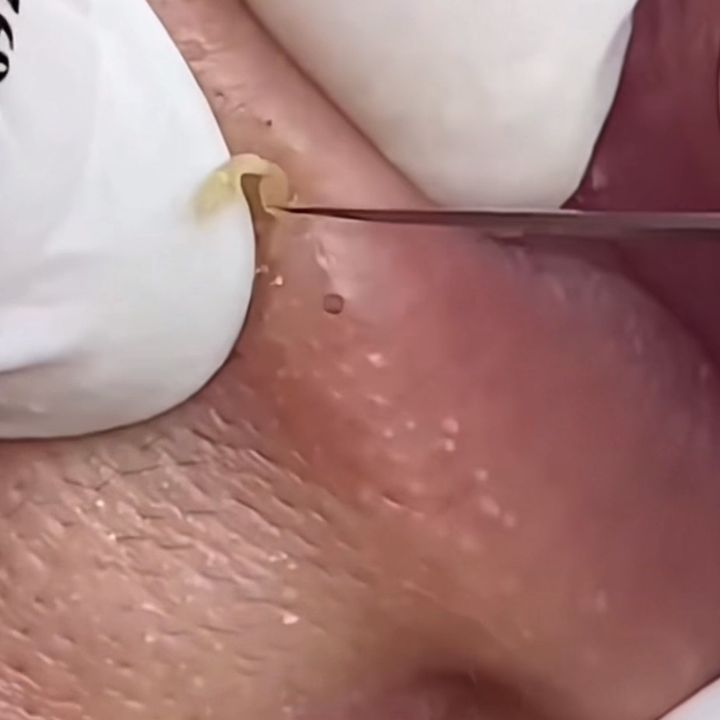 pimpleskin