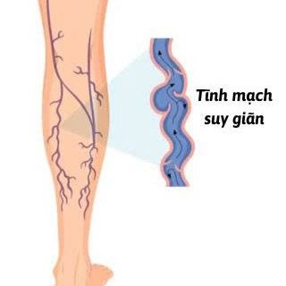 360° SUY GIÃN TĨNH MẠCH