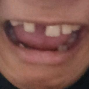 ฟันหลอ