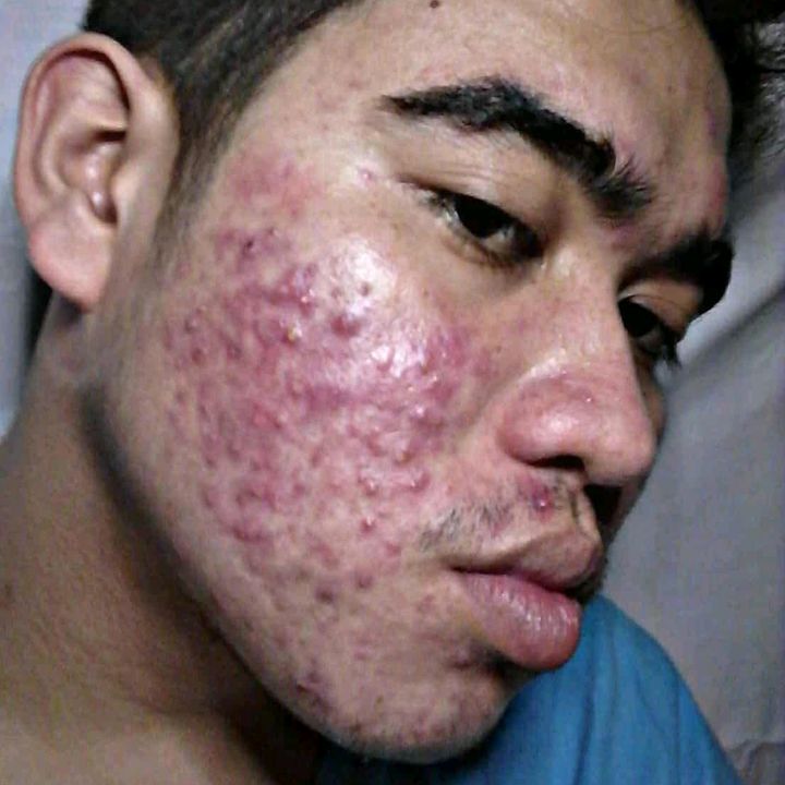 ACNE KING 2.0 👑