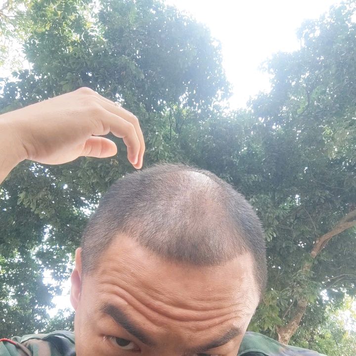 Mọc tóc đổi Ảnh đổi Tên !